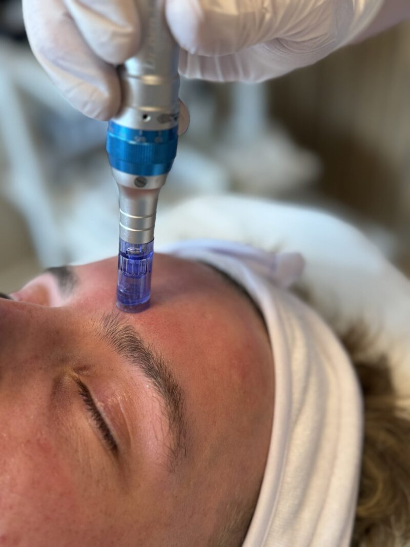Nanoneedling: Den nye standard for anti-aging behandlinger